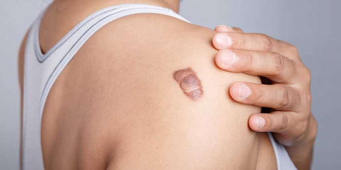 keloid_425