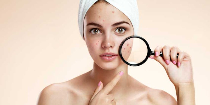 HormonalAcne425