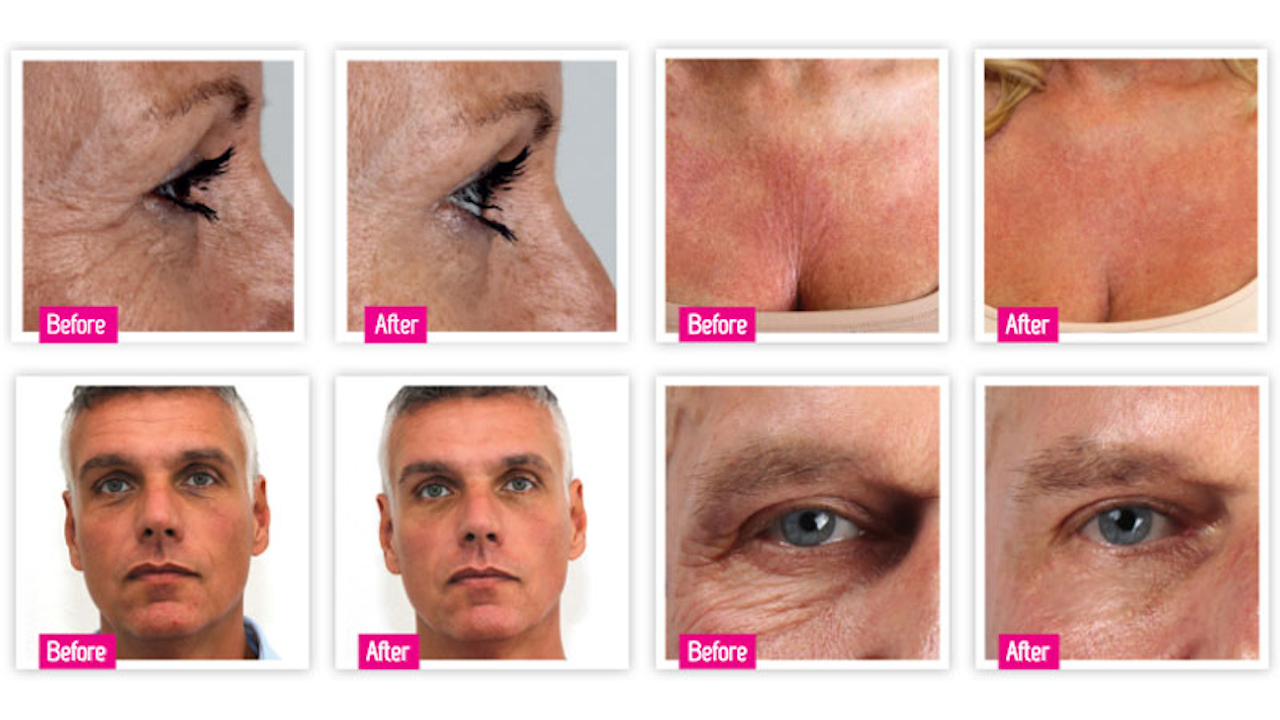 Dermatude DT-DM800 メタジェクト Dermatude DT-DM800 メタジェクト Dermatude DT-DM800 メタジェクト Dermatude DT-DM800 メタジェクト