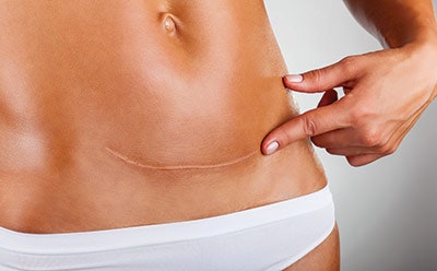 Si1805 Scars Dream 35386708 Belly Scar 400