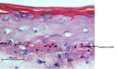 The second biopsy slide shows skin exposed to sun but with sunscreen applied 20 minutes before sun exposure. No sunburn cells are seen in the second biopsy slide where skin was protected with sunscreen before UV photo- exposure and was equivalent to skin in the dark.8 The epigenetic factor, sunscreen use, affects genes governing skin cancer development, photoaging, and other factors of skin health.