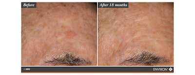 Vita-Botanical Mela-Fade Serum System A+B: two products that together contain an expertly blended combination of highly specialized, scientifically proven ingredients that may assist in improving the appearance of pigmentation through the effects of the inhibition of melanogenesis mediators, tyrosinase and melanosome transfer. Key ingredients include Lactic acid, Geranium Root, Artichoke Leaf extract, Ginger Lilies, Plum, Neem Leaf extract, Yoshino Cherry Leaf extract, Honeybush Leaf/Stem extract, and Panthenol.