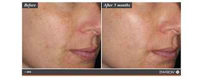 The entire system should be used both in the morning and night with the Environ Vitamin STEP-UP SYSTEM™ for best results. Most importantly, always apply a generous amount of SPF 15-30, containing UVA and UVB protectors.