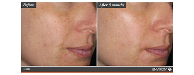 The entire system should be used both in the morning and night with the Environ Vitamin STEP-UP SYSTEM™ for best results. Most importantly, always apply a generous amount of SPF 15-30, containing UVA and UVB protectors.