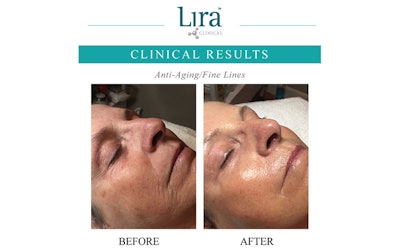 Why Hybrid Peels?