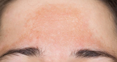 Passive: Hormonally induced trauma from inside out, due to endocrine and other hormonal flux. i.e., 'Pregnancy Mask' across the nose and cheeks or large defined melasmas after a certain age or menopause. This is the most difficult to remove because the practitioner must address the cortisol levels, stress levels and blocking melanogenesis at the front door of the warehouse that supplies pigment to the melanocyte itself. It is called The Golgi Apparatus, second to the Mitochondria, it is the most primary organelle in the human cell. Think of it as the post office or UPS/FedEx that sends the goods throughout the cell structure which keeps everything maintained.