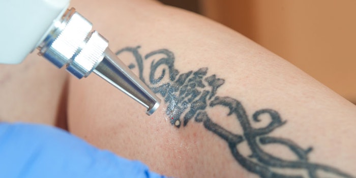 tattooremoval_np
