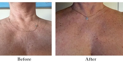 Light-activated GlycoAla produces impressive results but with less discomfort, downtime, side effects and cost often associated with more aggressive techniques. This unique combination of high effectiveness and low risk makes GlycoAla an ideal option to attract patients who desire non-invasive, low-risk treatments. Also, it has cost effectiveness and a high ROI for your practice.