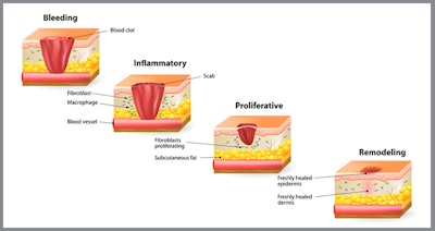 Scars are formed via an accelerated rate of new skin cells rushing to the surface to heal a breach in the tissue to prevent ulceration or sepsis. All cell proliferation has a rhythm of arrival at the site of injury, insuring a smooth and natural remodeling of tissue. If they arrive too fast, a hypertrophic, linear or keloid scar will form (raised). If they arrive too slow, then a cuneiform (acne) scar appears.