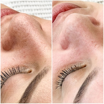 HydroLuxx-facial-before-after