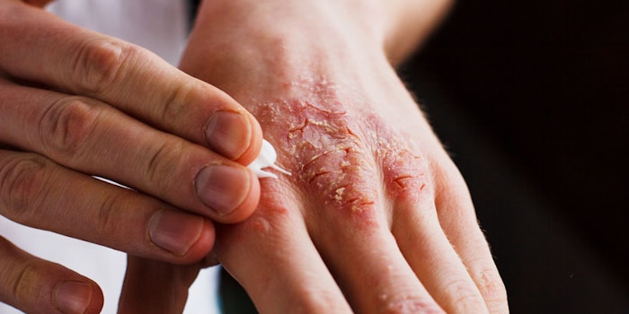 psoriasisresearchtreatment_np