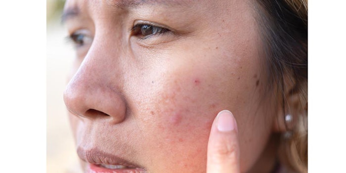 melasmavhyper-850x425