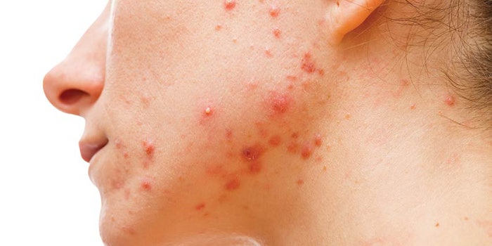SI2009_Acne_Sarfati_dreamstime_xxl_38079453_850np