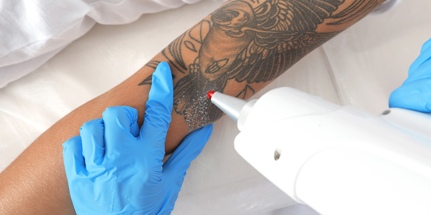 Laser Tattoo Removal in Colorado Springs  The New Canvas