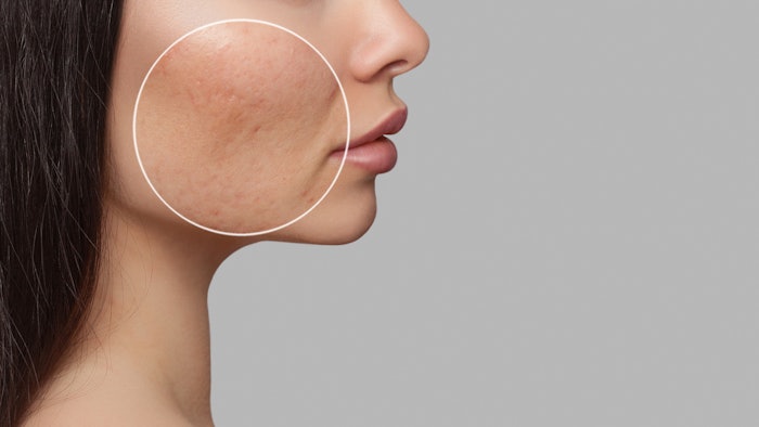 Woman with acne scars