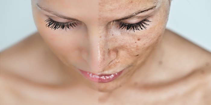 sun spot treatments skin