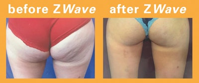 Zimmer Me2104 Image3