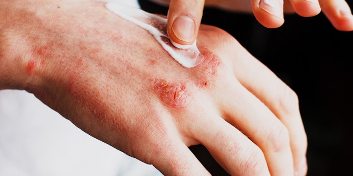 eczema skin flare up tips
