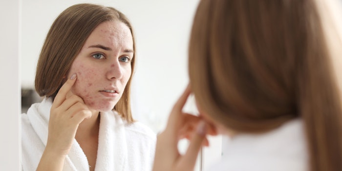 Skin purging tends to last about 21 days to a month.