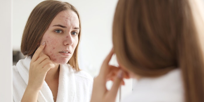 Searches for 'how to get rid of pimples on chin overnight' increased 2,500%.
