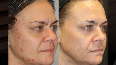 Before and after laser skin resurfacing with the Alma Hybrid 10,600 nm (CO2)/1570 nm laser.