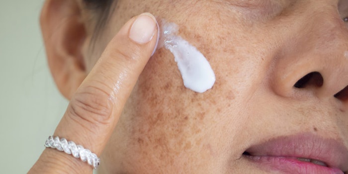 Melasma is the darkening or discoloration of the skin.