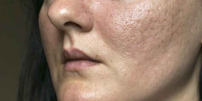 fractionalradiofrequency_np