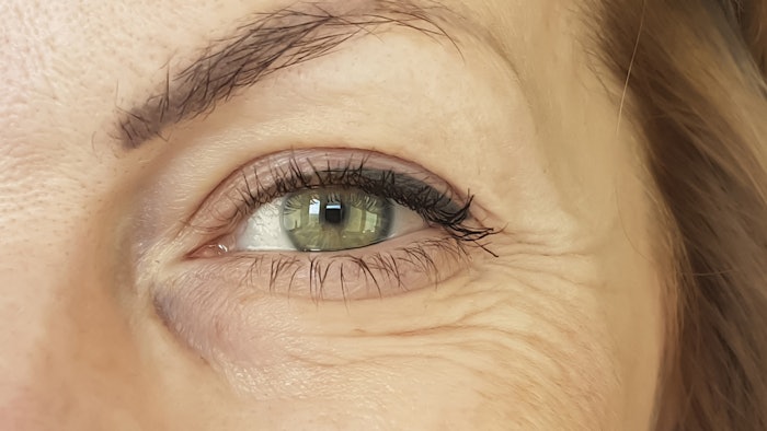 Subject assessment showed high satisfaction and treatment tolerability for nanofractional RF.