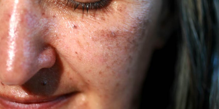 Post-summer skin issues from overexposure to the sun typically can't be treated with topicals alone and require in-office treatments, according to an article from the Seattle Times.