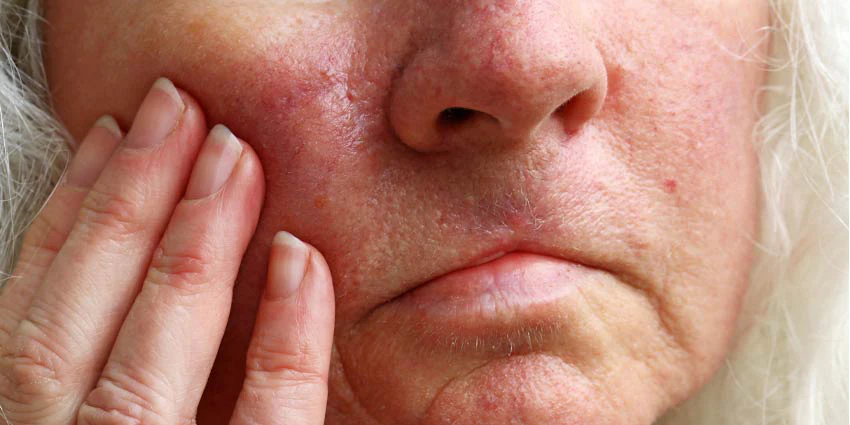 How to Treat Congested Skin | Skin Inc.