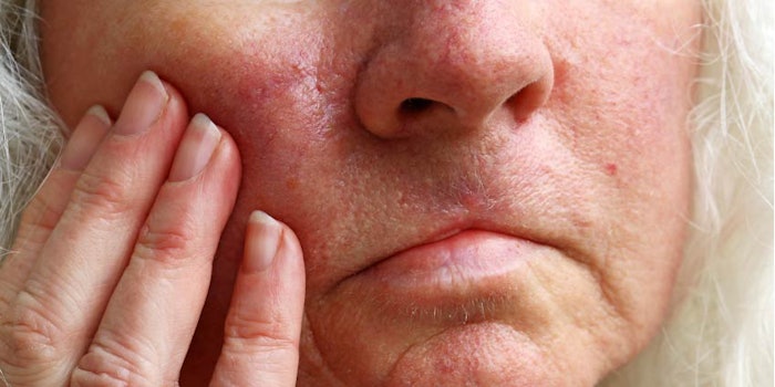 Congested skin can be treated with home remedies including natural exfoliation and dietary changes or prescription skin care products, according to Heathline.