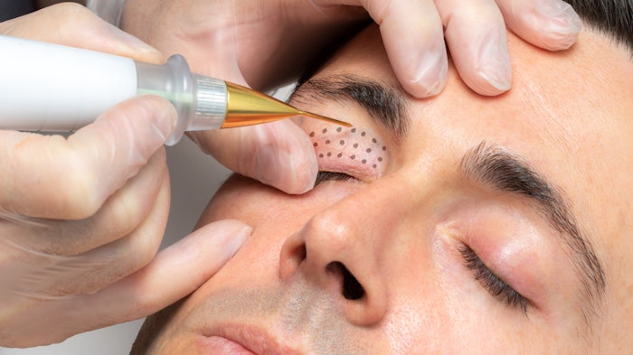 Man getting plasma treatment on upper eyelid