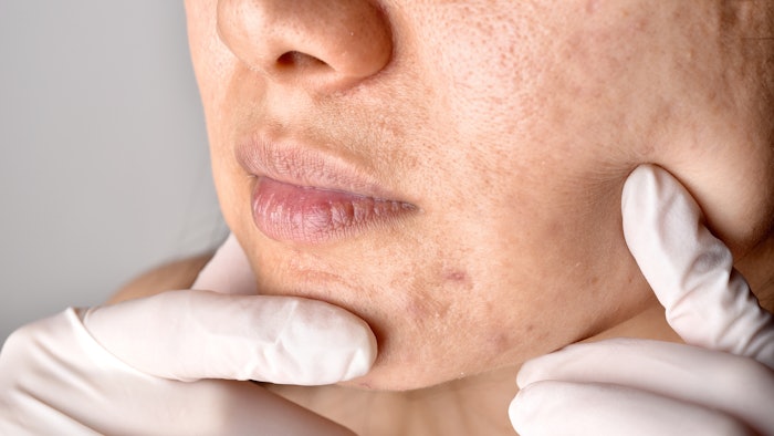 Doctor examining patient with acne scars.