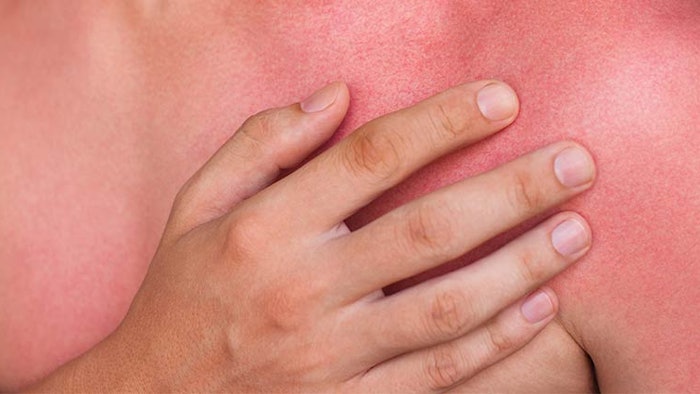 Person with bad sunburn