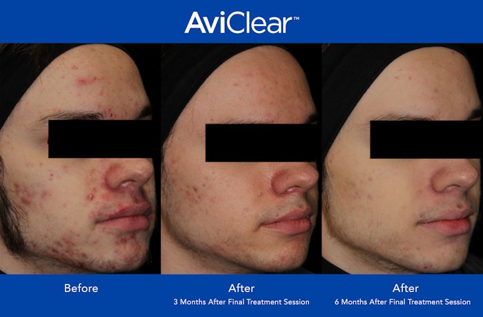 AviClear treatments provided visible improvement in the severity and freqiency of acne at six months after completion of the treatment protocol for 90% of patients.