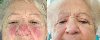 Woman Red Face Before After