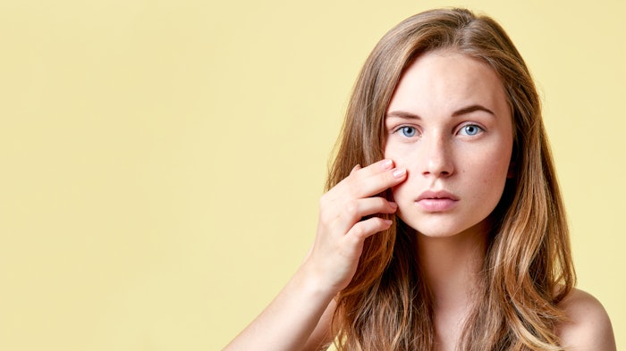 Skin Concern Stigmatization Assessment is validated