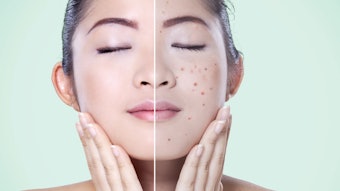 The Do’s and Don’ts of Treating Acneic Clients