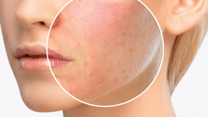 The Main Cause of Allergic Reactions