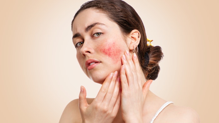 AARS Introduces #RosaceaRescues During Rosacea Awareness Month