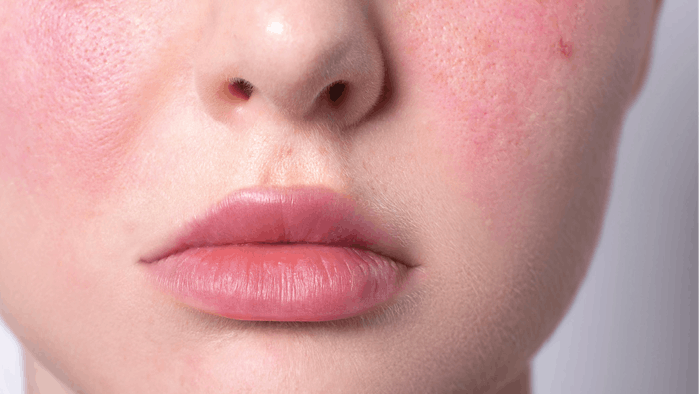 We’ve compiled some of our favorite sensitive skin protocols that will help clients glow both inside and out.