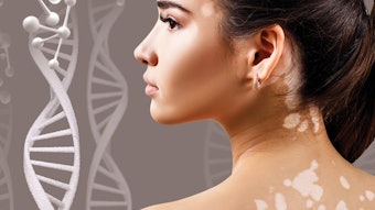 How to Choose the Best Ingredients to Treat Pigmentation