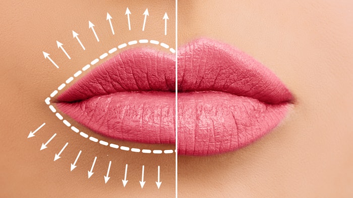 Comparison of lips with and without lip filler.
