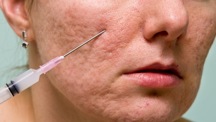 woman receiving filler injection for acne scars