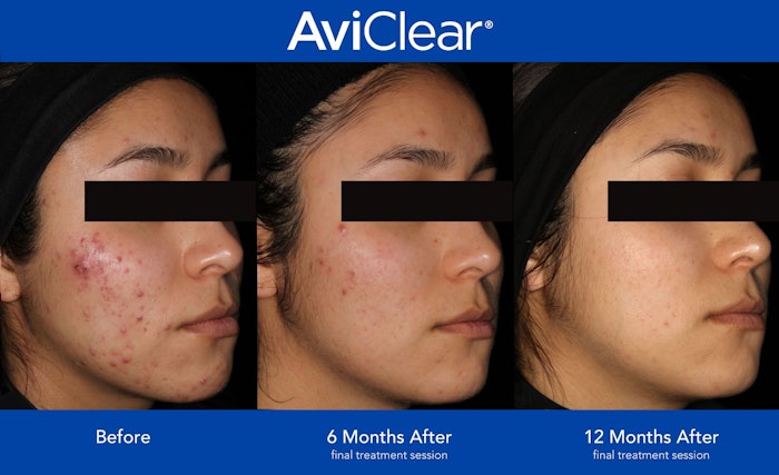 Cutera AviClear 1,726 nm Acne Laser results