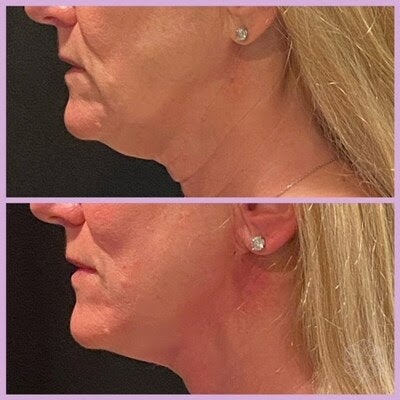 PDO Max Duo is used for deep plane thread lifts to the temporal fascia.