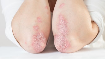 woman with psoriasis