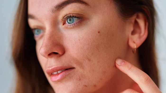 Woman looking at acne