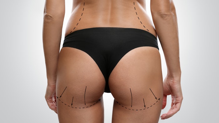 woman evaluated for BBL