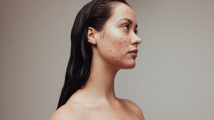 See how beneficial bacteria can help aid your acne treatments.